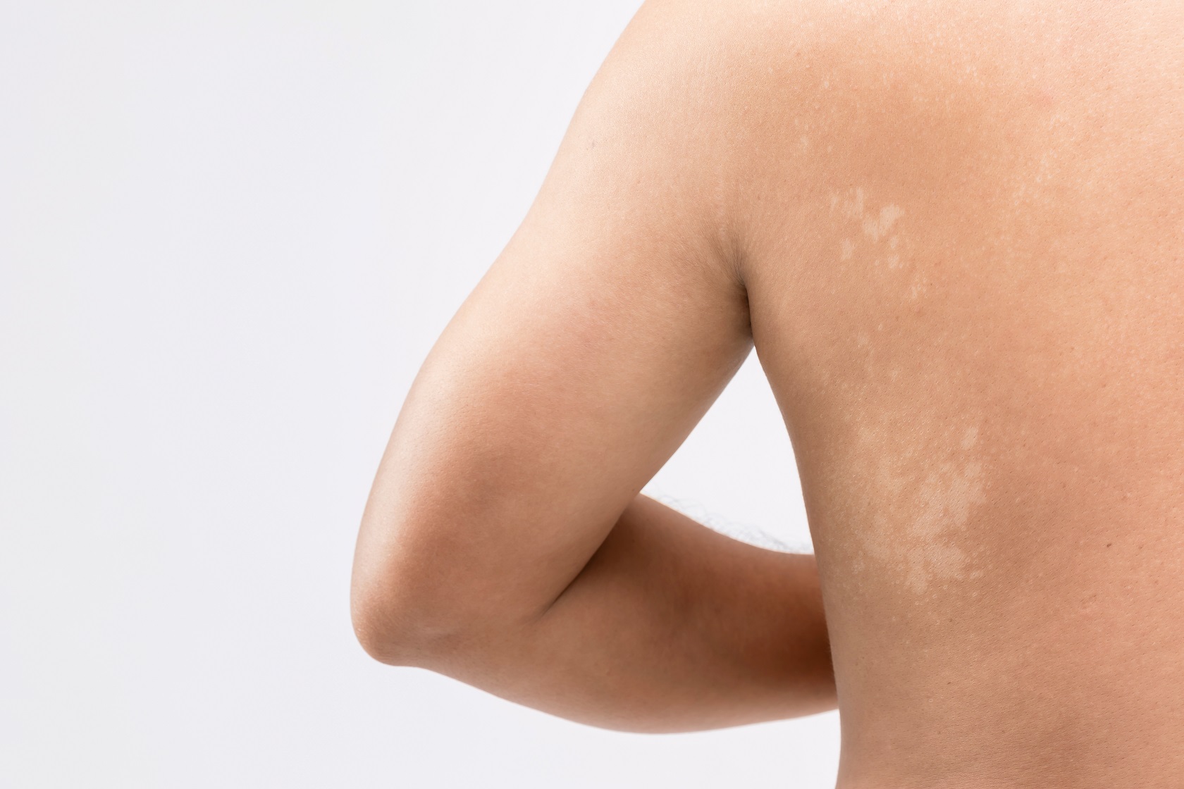 Tinea versicolor causes, symptoms and treatment TeleMed2U